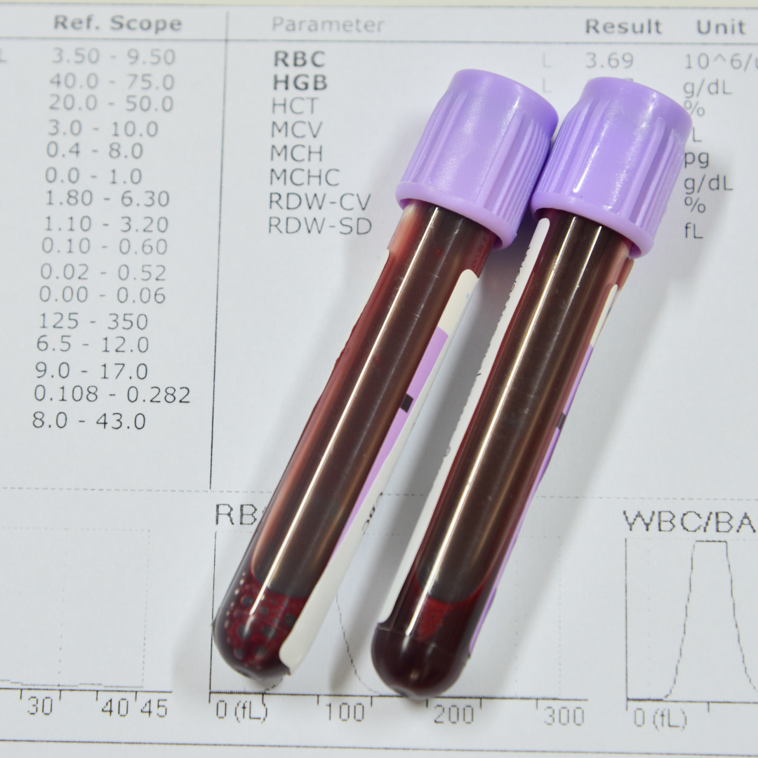 Morfologia krwi - jak się przygotować do badania? Morfologia krwi - jak się przygotować do badania?