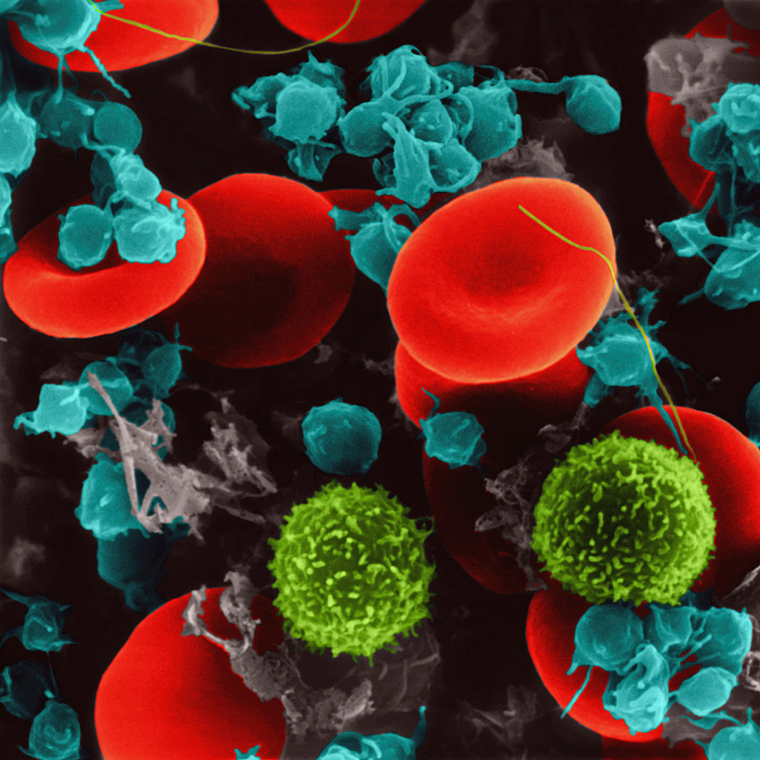 Stres a poziom limfocytów we krwi - jaka jest zależność między nimi? Stres a poziom limfocytów we krwi - jaka jest zależność między nimi?