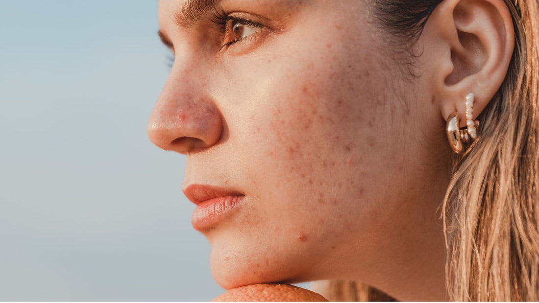 Czy kolagen pomaga na trądzik?