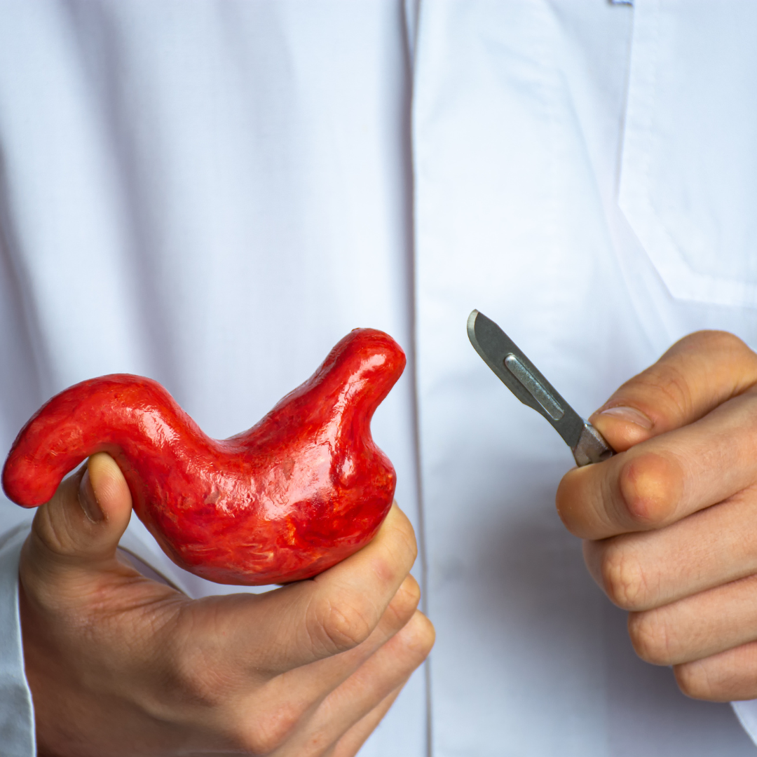 Zmniejszenie żołądka - na czym polega i kiedy można je wykonać?